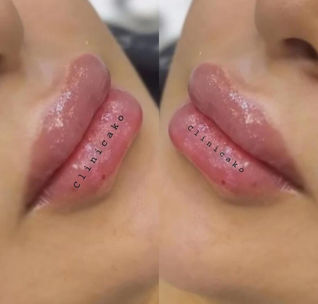 آموزش و خدمات تخصصی لیزر مزوتراپی ژل و بوتاکس آکو در اندیمشک خوزستان