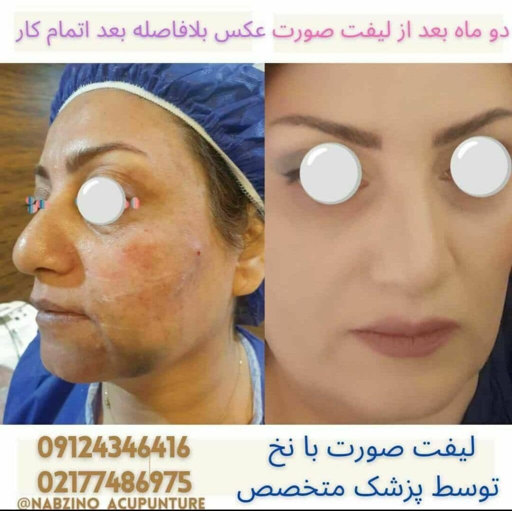 کلینیک تخصصی زیبایی لیفت نخ و طب سوزنی نبضی نو در تهران