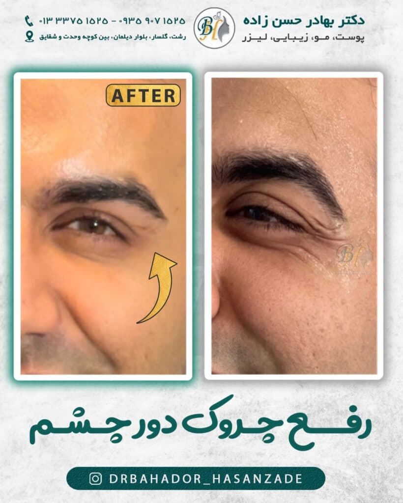 کلینیک زیبایی ژل لب خط خنده گونه دکتر بهادر حسن زاده در گلسار رشت