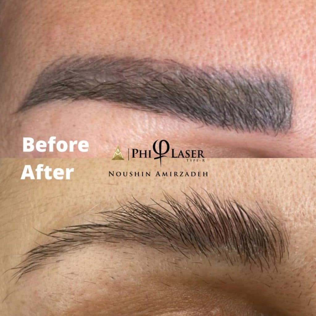 ریموو تاتو با لیزر آکادمی امیرزاده در اصفهان