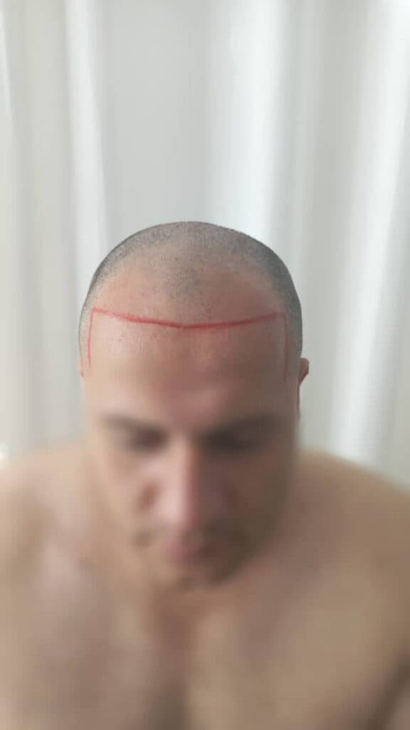 کلینیک کاشت مو وی آر VR در شهریار