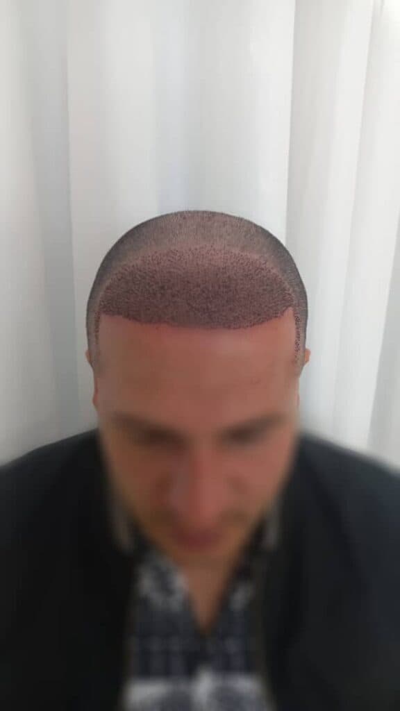 کلینیک کاشت مو وی آر VR در شهریار