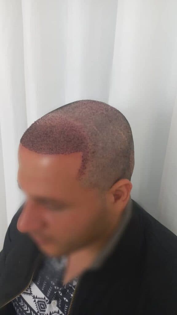 کلینیک کاشت مو وی آر VR در شهریار