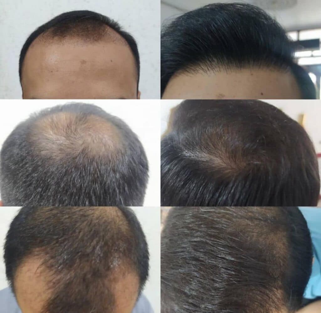 خدمات تخصصی کاشت مو و ابرو شیروانی در سنندج