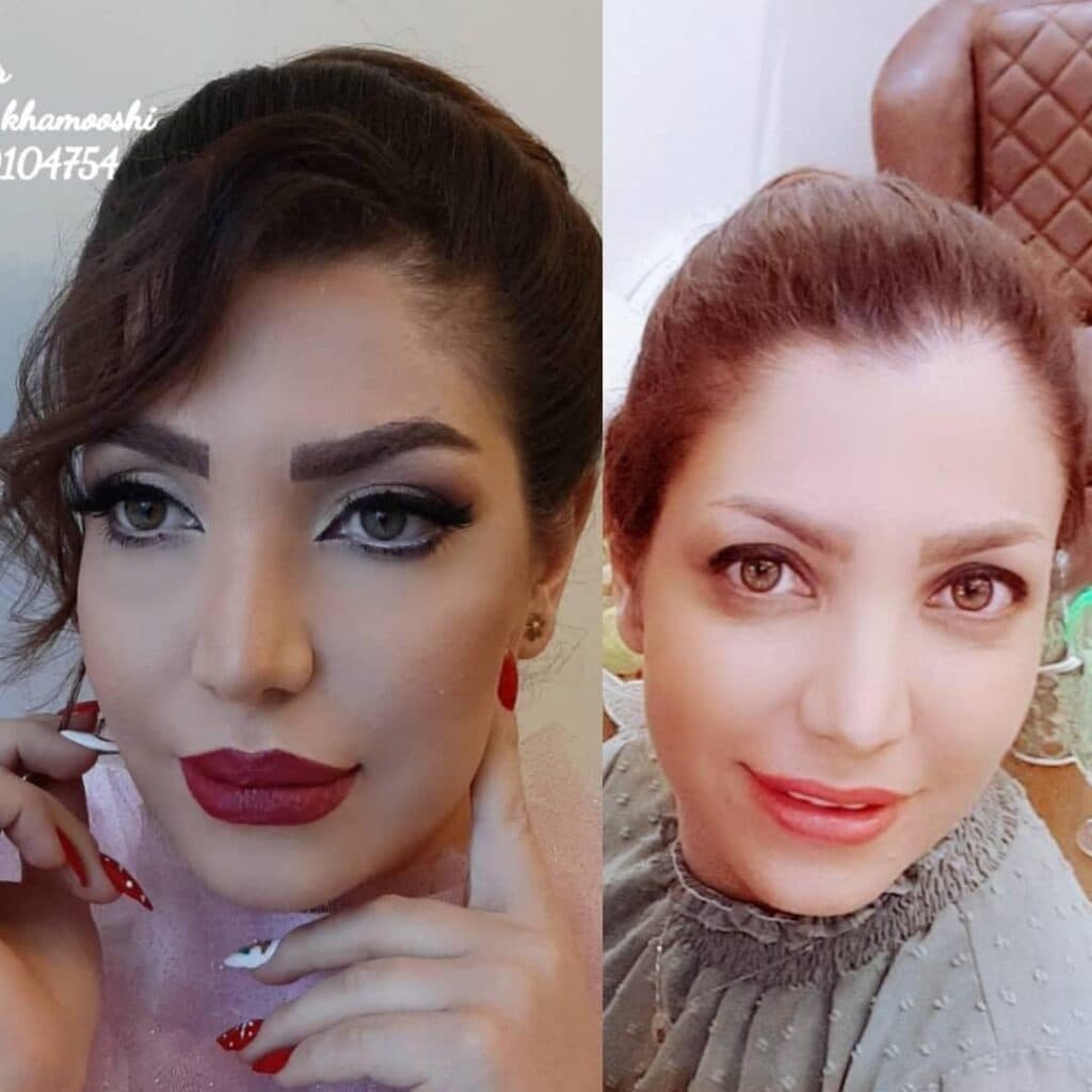 خدمات تخصصی کاشت مو و ابرو شیروانی در سنندج