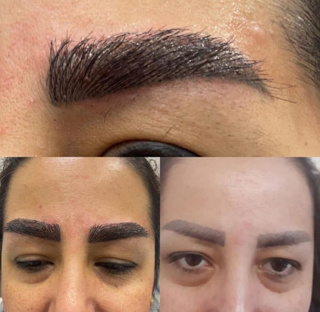 خدمات تخصصی کاشت مو و ابرو شیروانی در سنندج