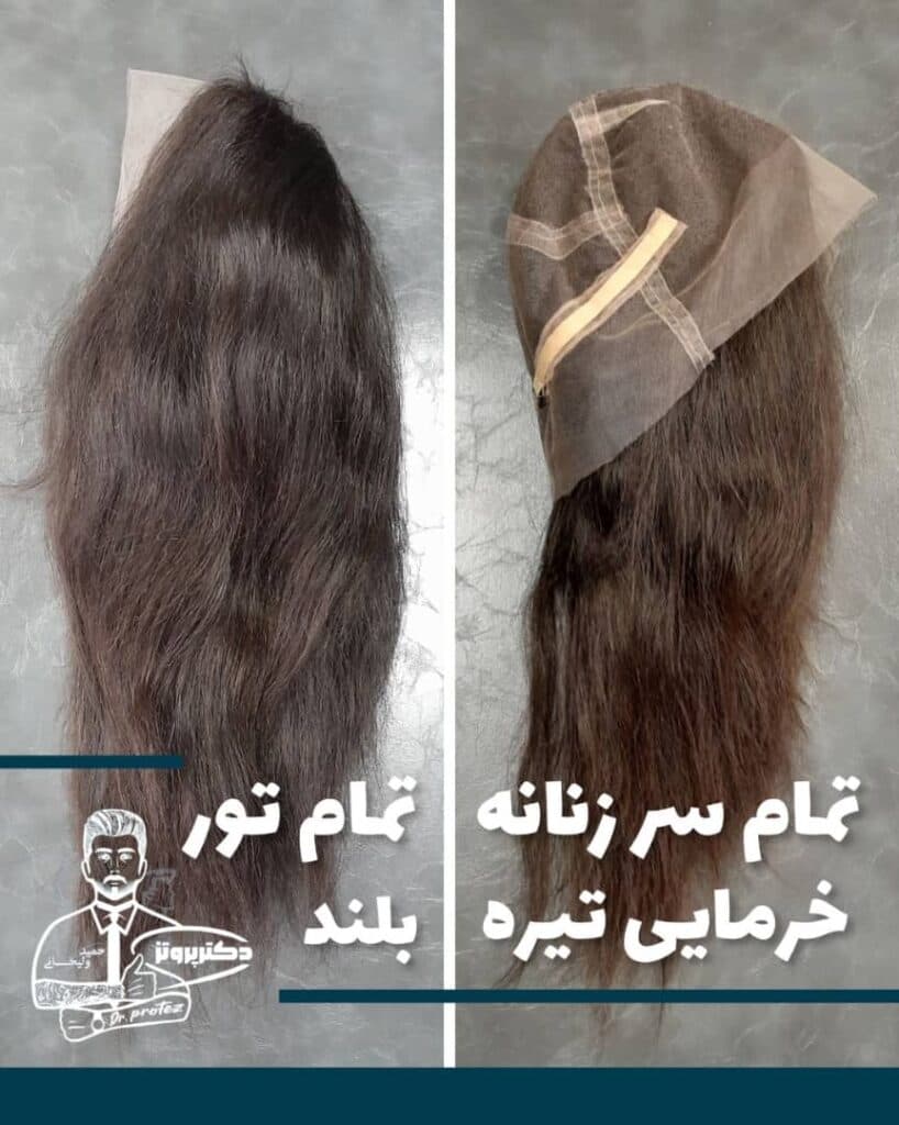 پروتز مو دکتر حمید ولیخانی در اصفهان