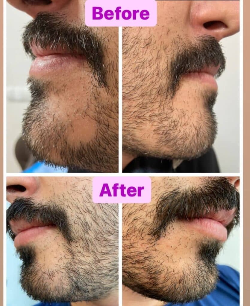خدمات تخصصی زیبایی لیزر موهای زائد مرکز تخصصی ایپک در تبریز