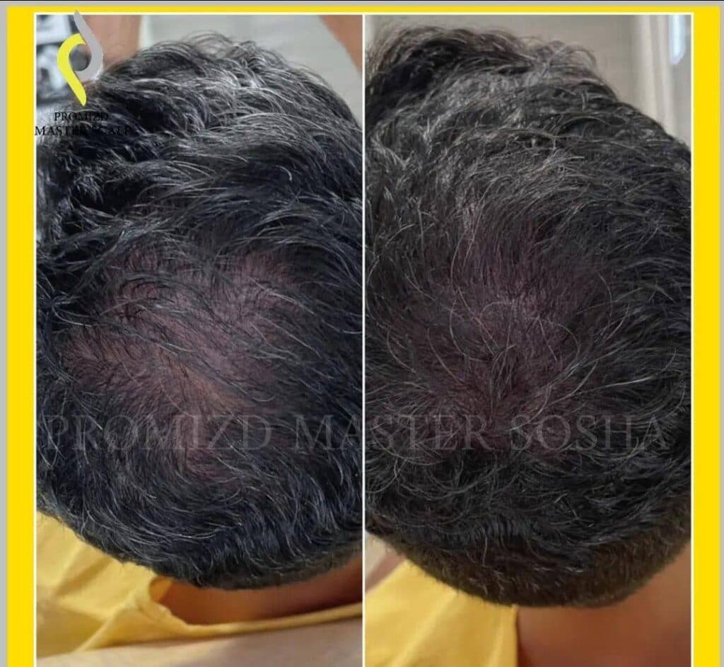 مرکز آموزش و خدمات میکرواسکالپ و اسکالپ سر سوشا احمدی در تهران