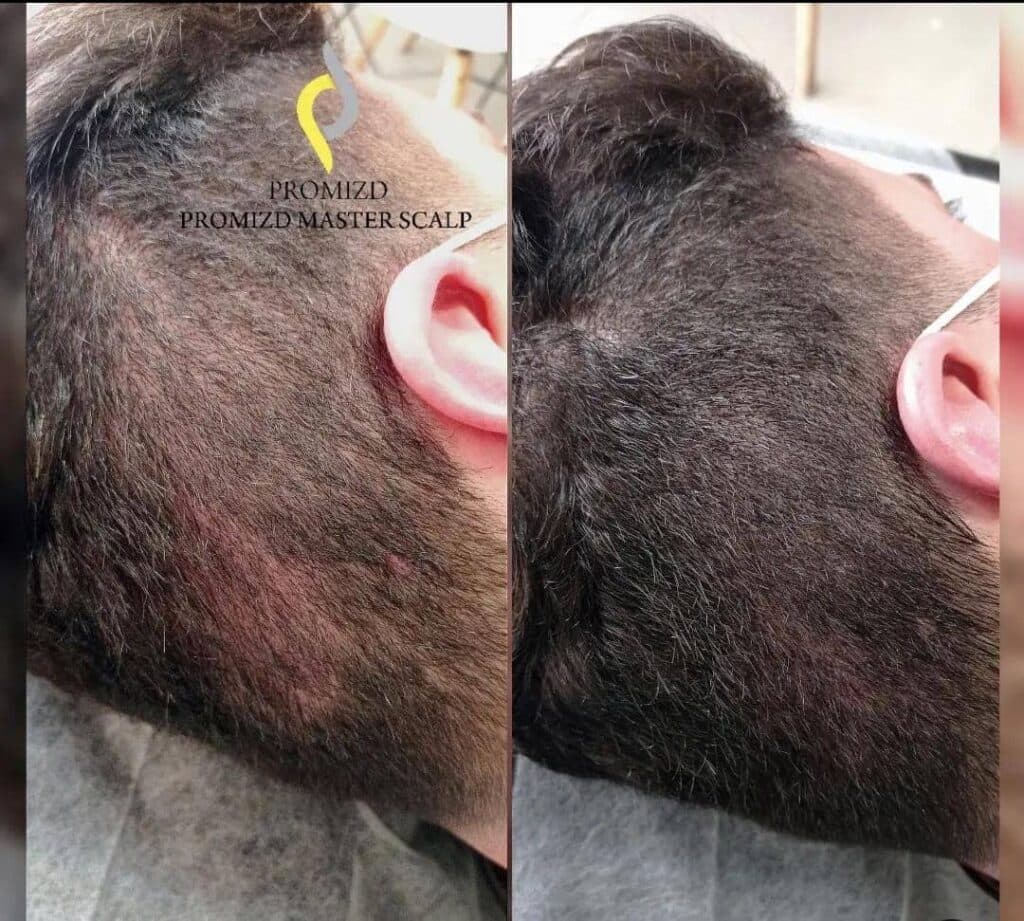 مرکز آموزش و خدمات میکرواسکالپ و اسکالپ سر سوشا احمدی در تهران