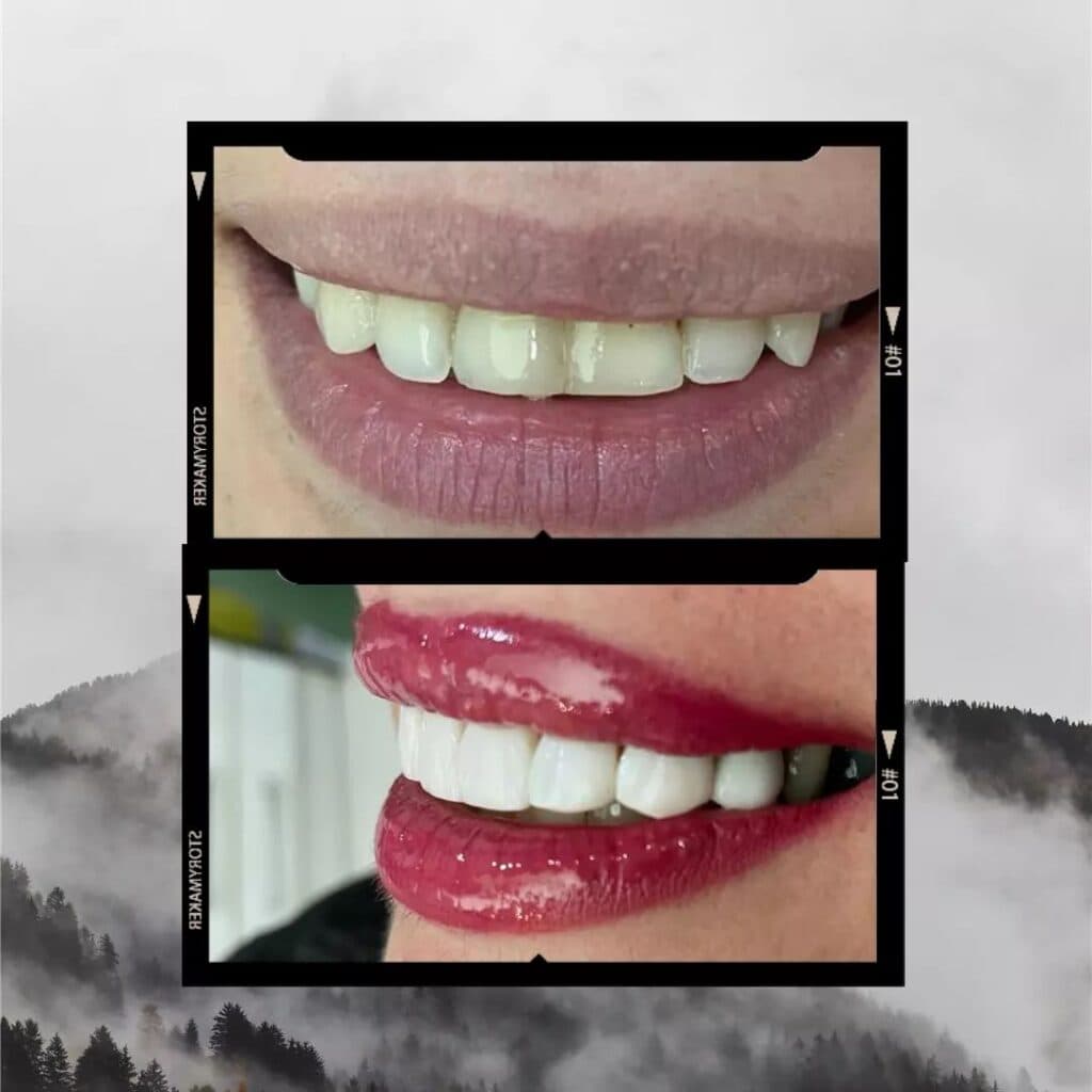 مرکز تخصصی لمینت ونیر کامپوزیت دنیای لبخند دکتر نسترن دنیادیده در مشهد