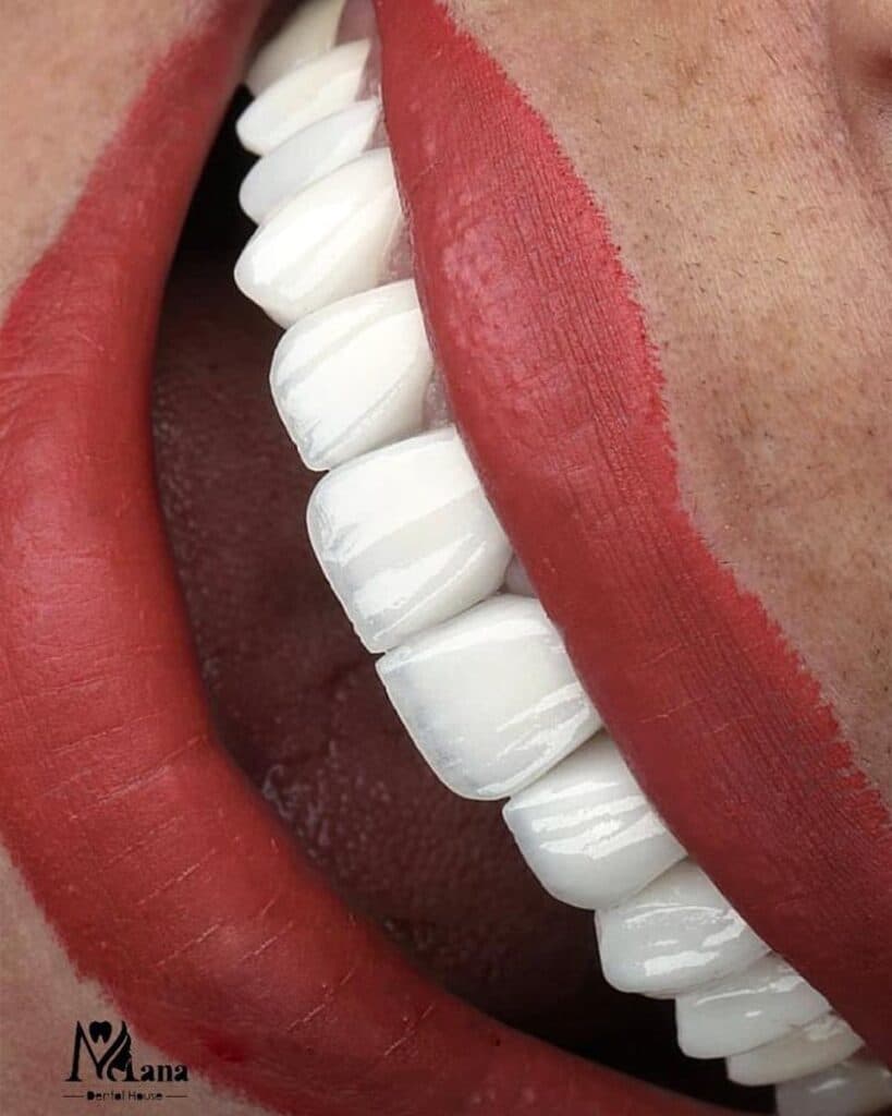 مرکز تخصصی لمینت ونیر کامپوزیت دنیای لبخند دکتر نسترن دنیادیده در مشهد