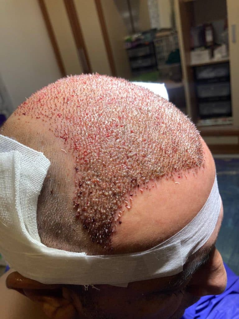 کلینیک تخصصی کاشت مو و ابرو کیارش در رشت