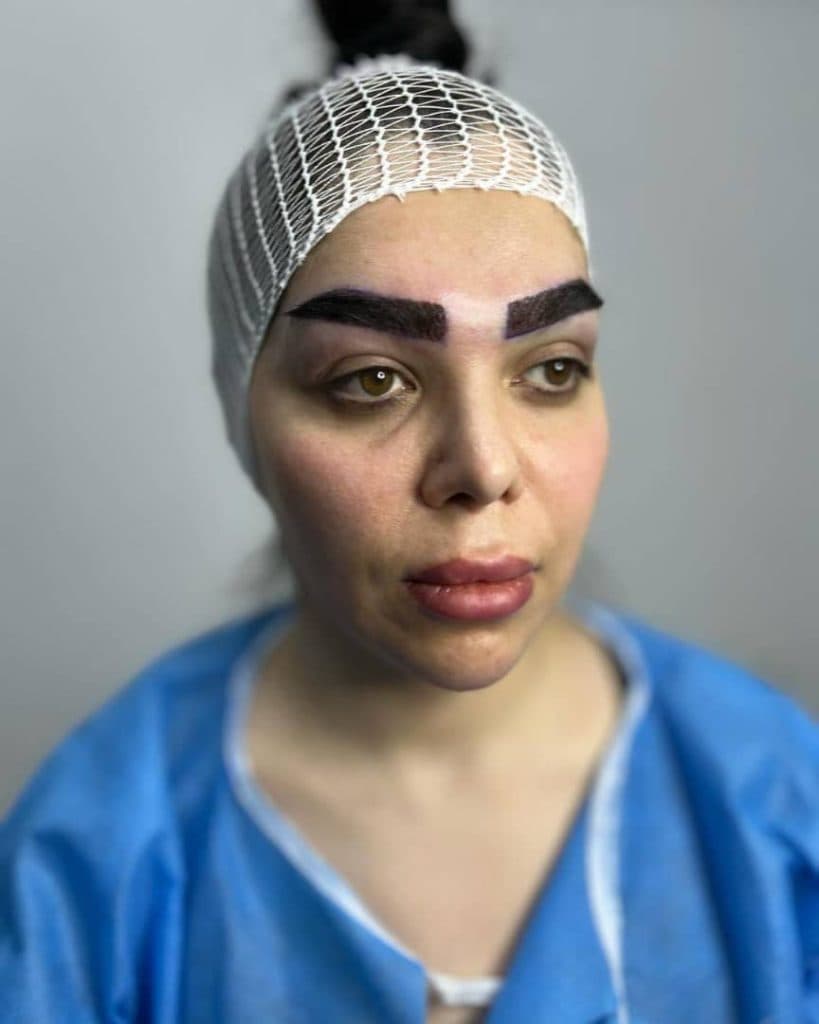 آموزش و خدمات کاشت مو و ابرو عباس زاده در تبریز