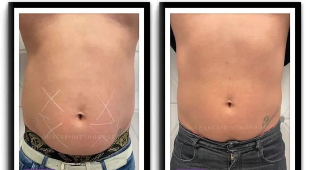 کلینیک زیبایی لاغری موضعی مریت در گلسار رشت