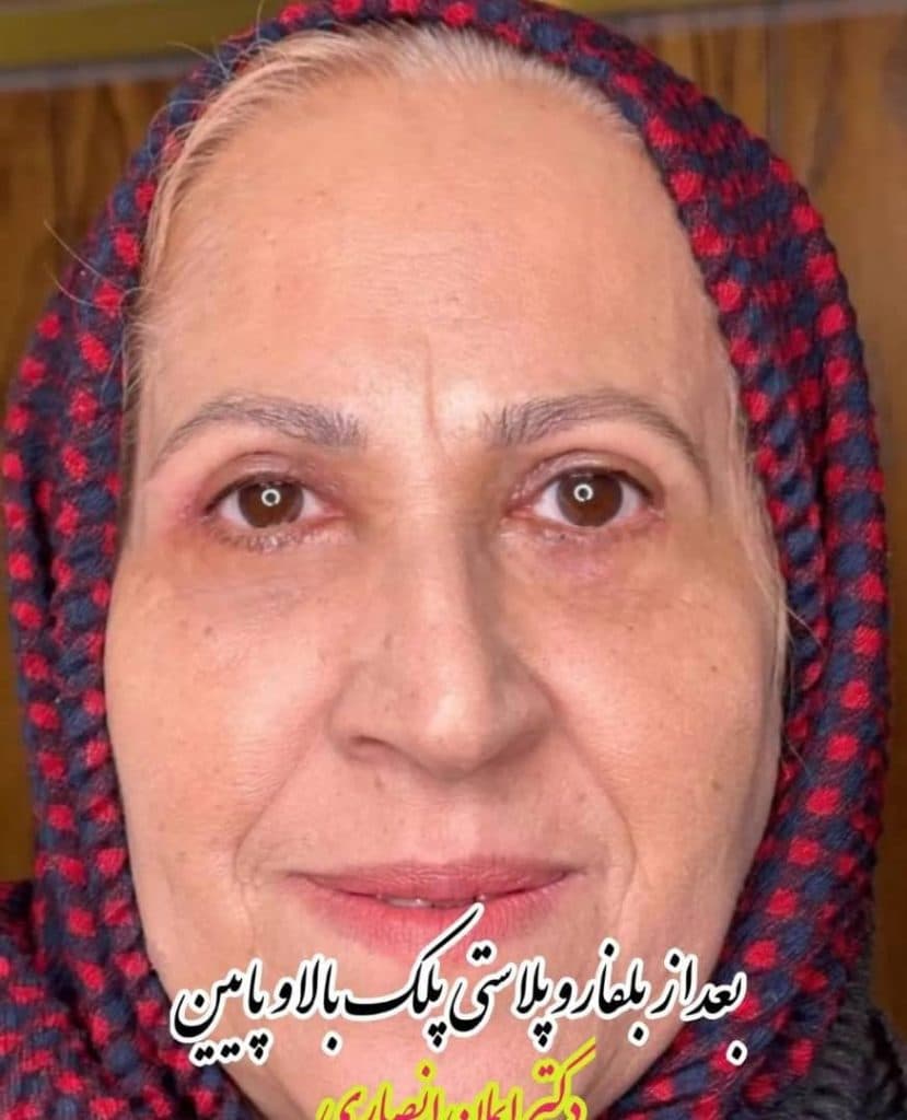 کلینیک تخصصی جراحی چشم و بلفاروپلاستی پلک کولایف در تهران