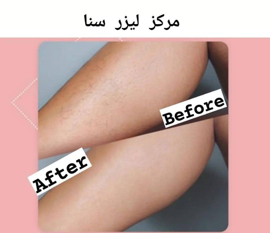 مرکز تخصصی لیزر موهای زائد سنا در کرمان