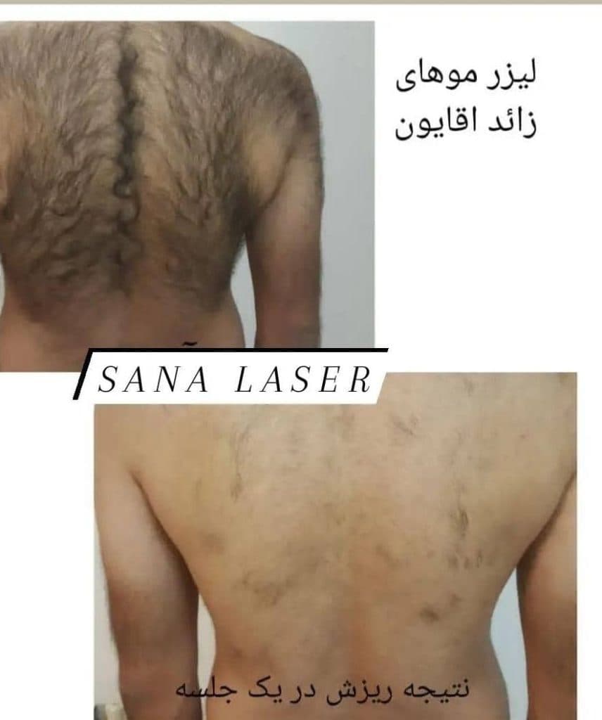 مرکز تخصصی لیزر موهای زائد سنا در کرمان