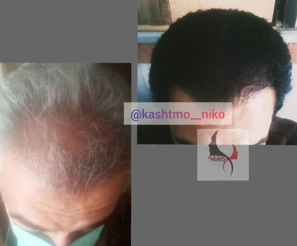 خدمات تخصصی کاشت مو نیکو در تهران