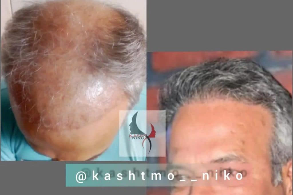 خدمات تخصصی کاشت مو نیکو در تهران