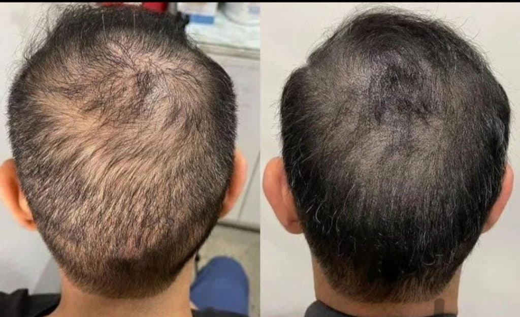 خدمات میکرواسکالپ و اسکالپ سر مریم شکری در مهرشهر کرج