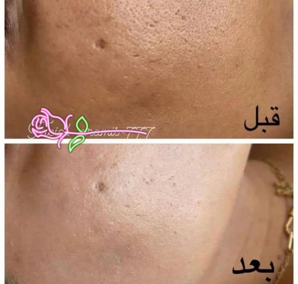 خدمات تخصصی فشیال و پاکسازی پوست صدیقه خیرمند در رفسنجان