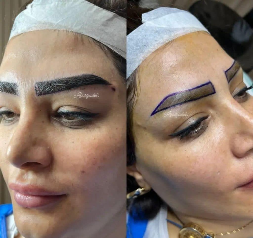 آموزش و خدمات کاشت مو و ابرو عباس زاده در تبریز