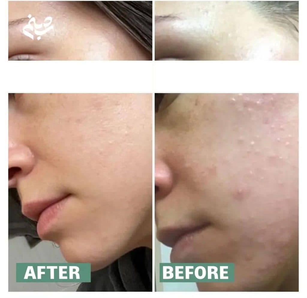 آموزش و خدمات پاکسازی پوست و فیشیال صورت شبنم دهبکری در مهاباد