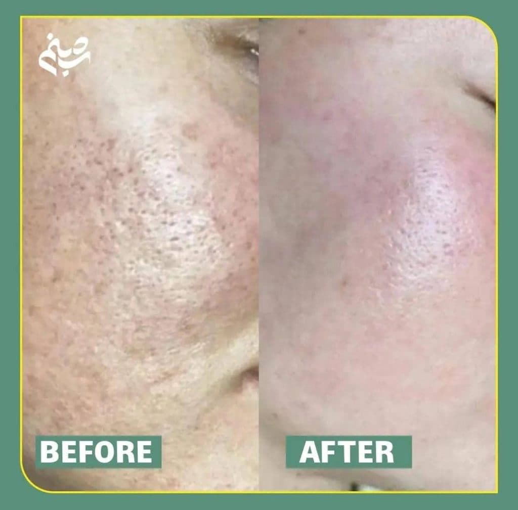 آموزش و خدمات پاکسازی پوست و فیشیال صورت شبنم دهبکری در مهاباد