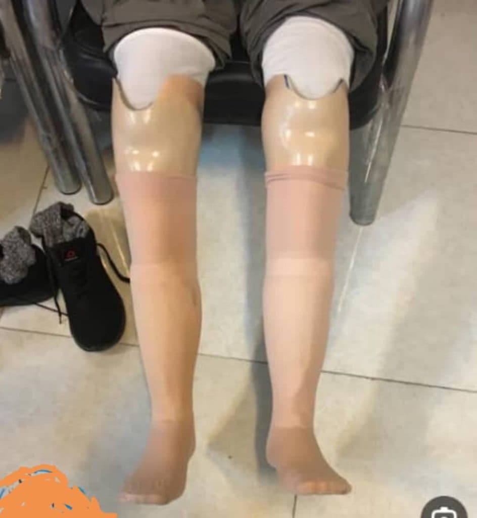 طراحی و ساخت کفی طبی و پروتز ارتوپدی فنی توان بخش در شیراز