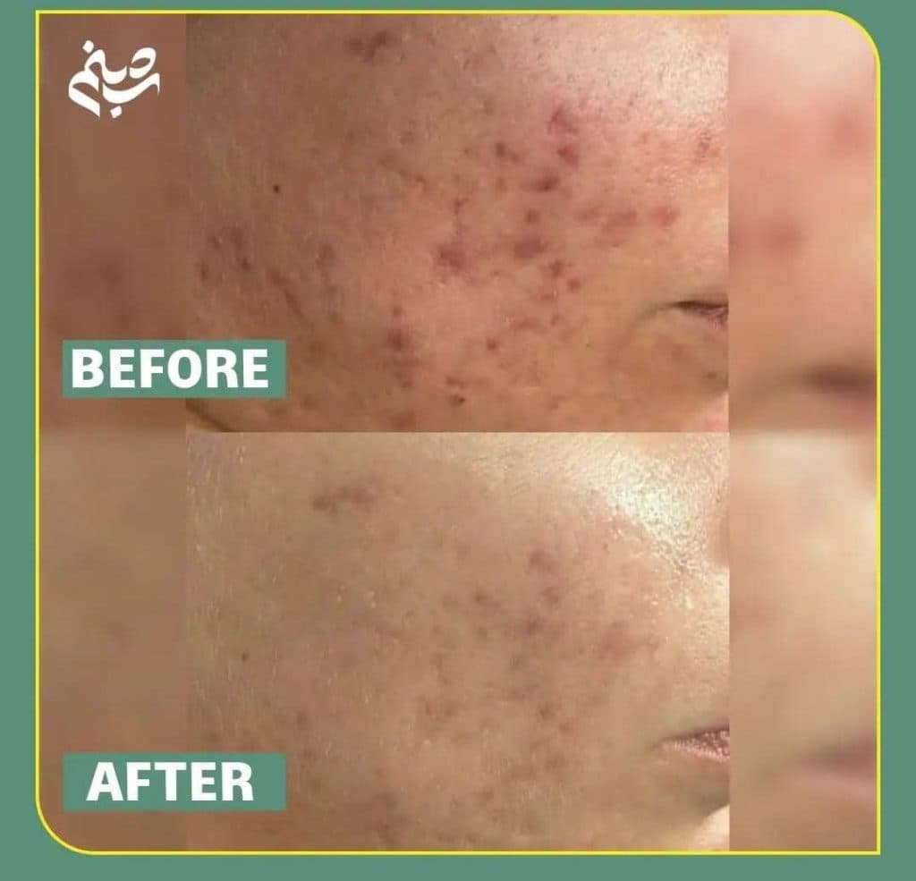 آموزش و خدمات پاکسازی پوست و فیشیال صورت شبنم دهبکری در مهاباد