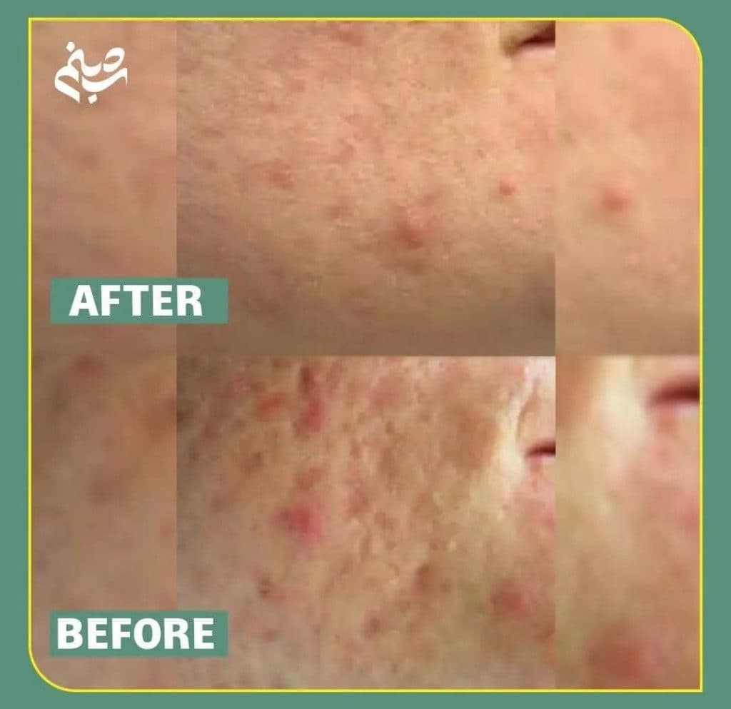 آموزش و خدمات پاکسازی پوست و فیشیال صورت شبنم دهبکری در مهاباد