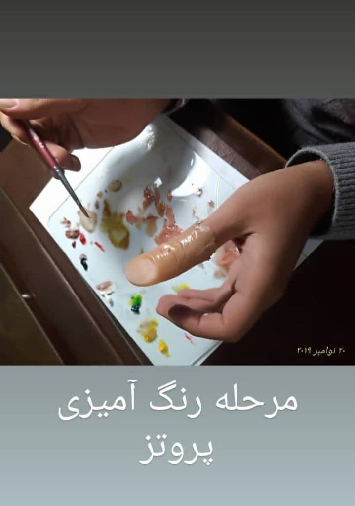 طراحی و ساخت دست و انگشت مصنوعی ارتوپد فنی یزدان در یزد