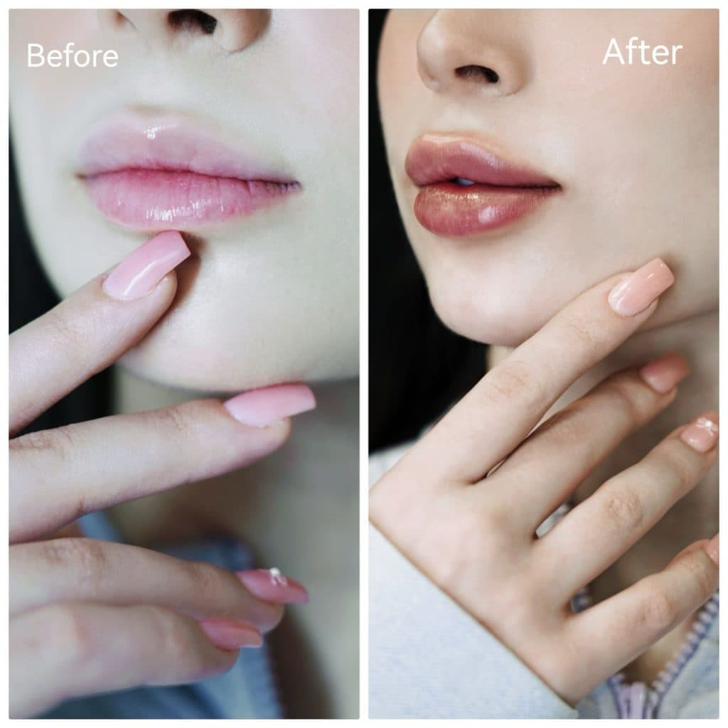 خدمات تخصصی تزریق فیلر لب روسی شاهرودی طب در سعادت آباد تهران