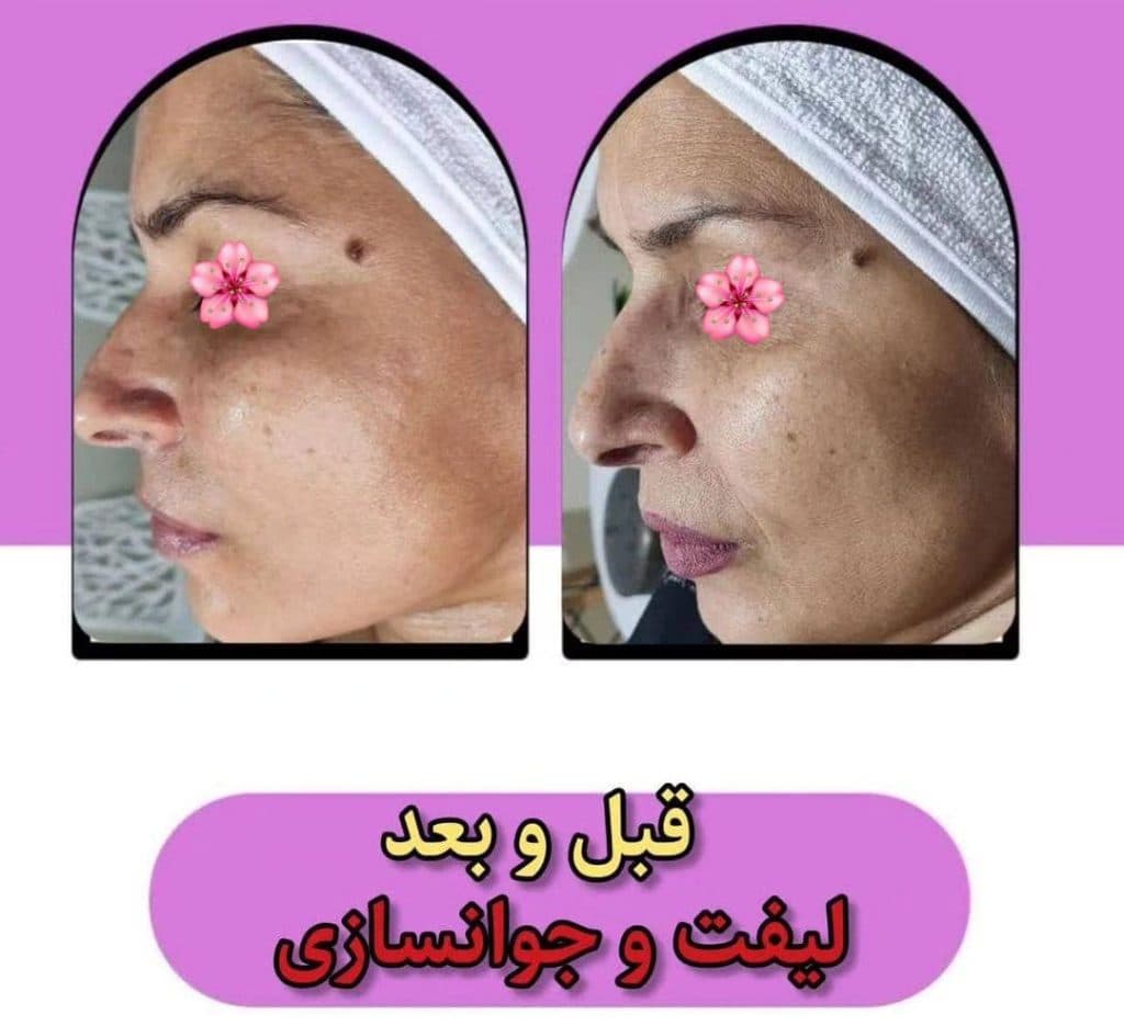 خدمات تخصصی پاکسازی پوست و فیشیال صورت شادی ملکشاهی در اصفهان