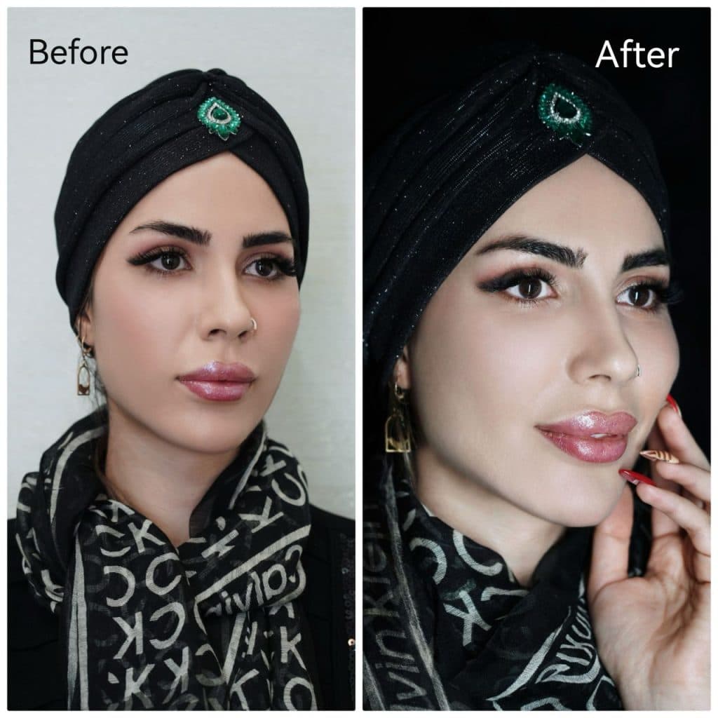 خدمات تخصصی تزریق مزوژل جوانساز شاهرودی طب در سعادت آباد تهران