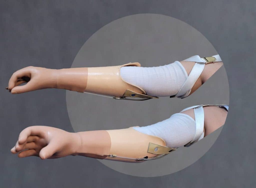 طراحی و ساخت دست و انگشت مصنوعی ارتوپد فنی یزدان در یزد