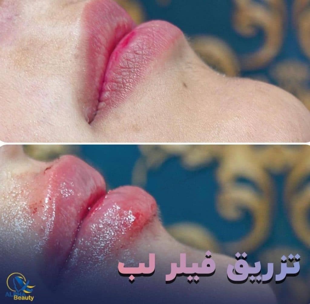 خدمات تخصصی تزریق فیلر لب و بوتاکس آلفا در مریوان
