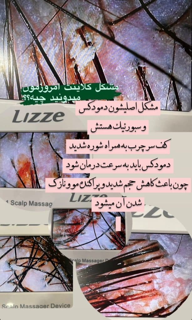 اسکالپ کف سر مهسا جعفری در رشت