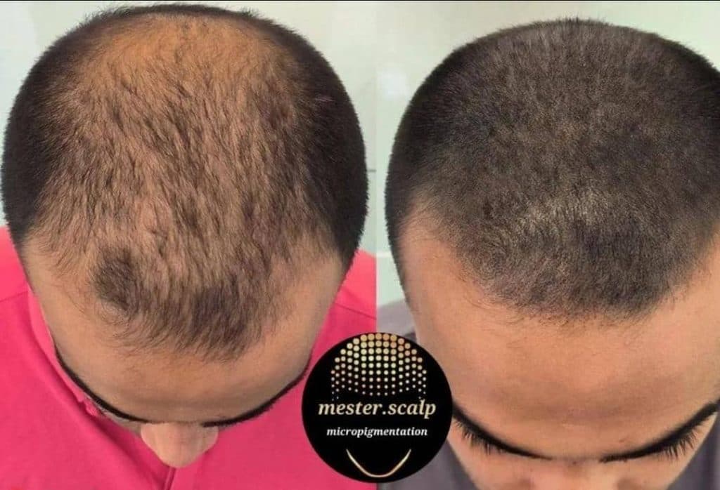 میکرو اسکالپ مستر اسکالپ در قم