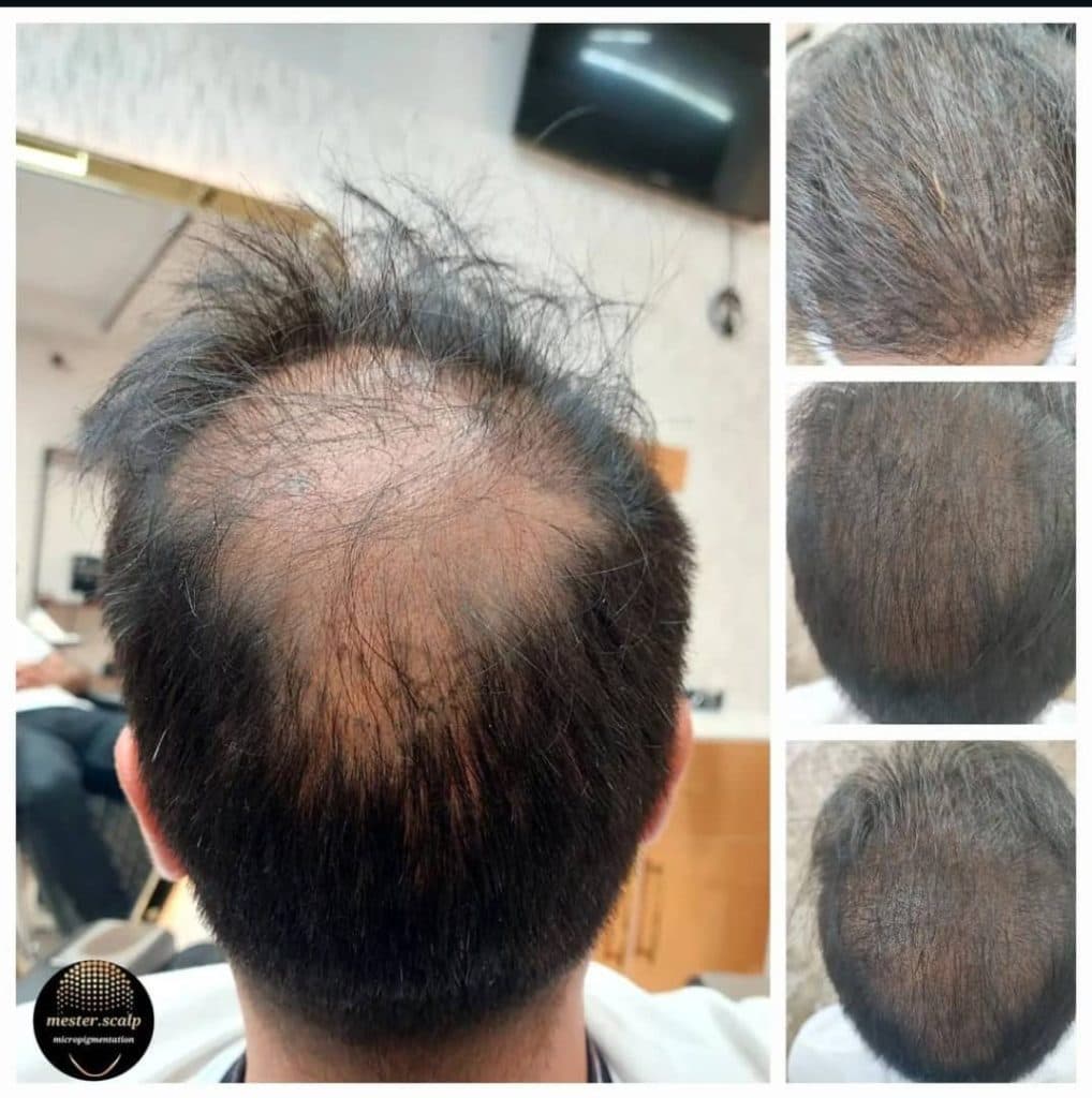 میکرو اسکالپ مستر اسکالپ در قم