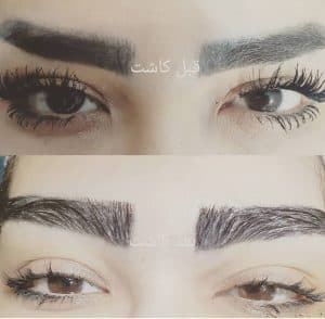 کاشت مو تخصصی امین مومنی در تهران