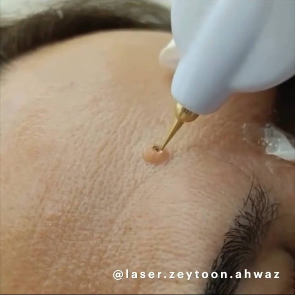 مرکز لیزر زیتون اهواز