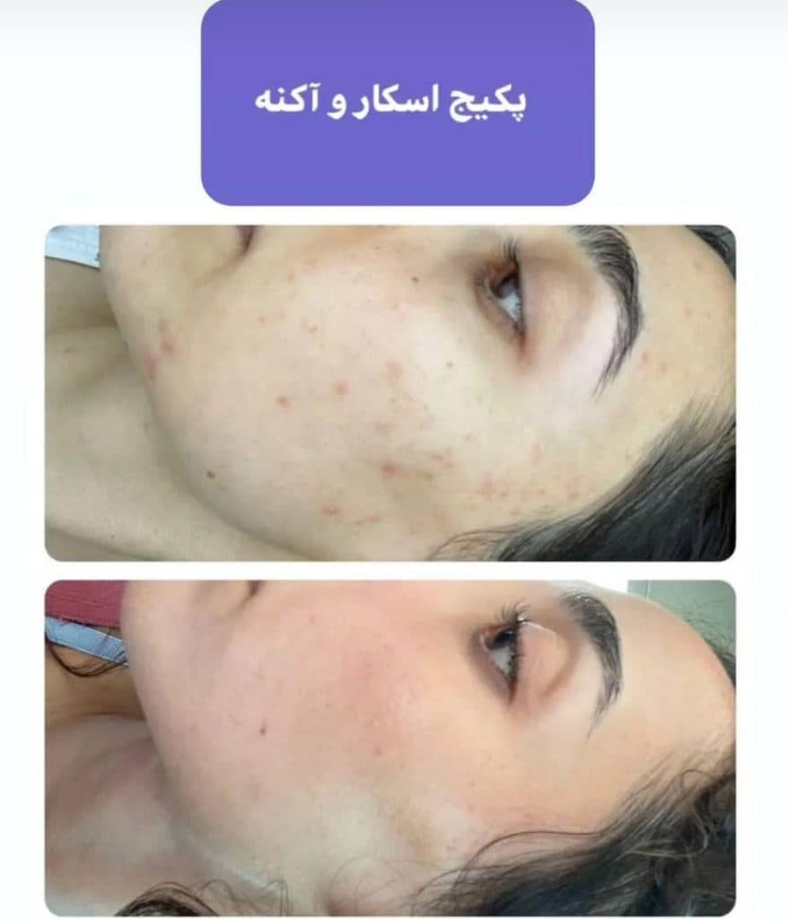 خدمات زیبایی و فیشیال پوست مهسا عبدالعلی زاده در تهران