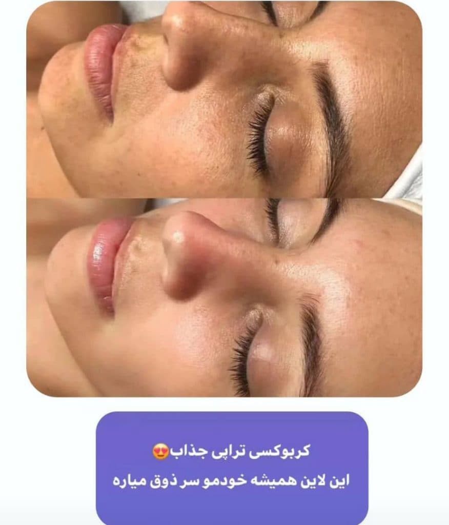 خدمات زیبایی و فیشیال پوست مهسا عبدالعلی زاده در تهران