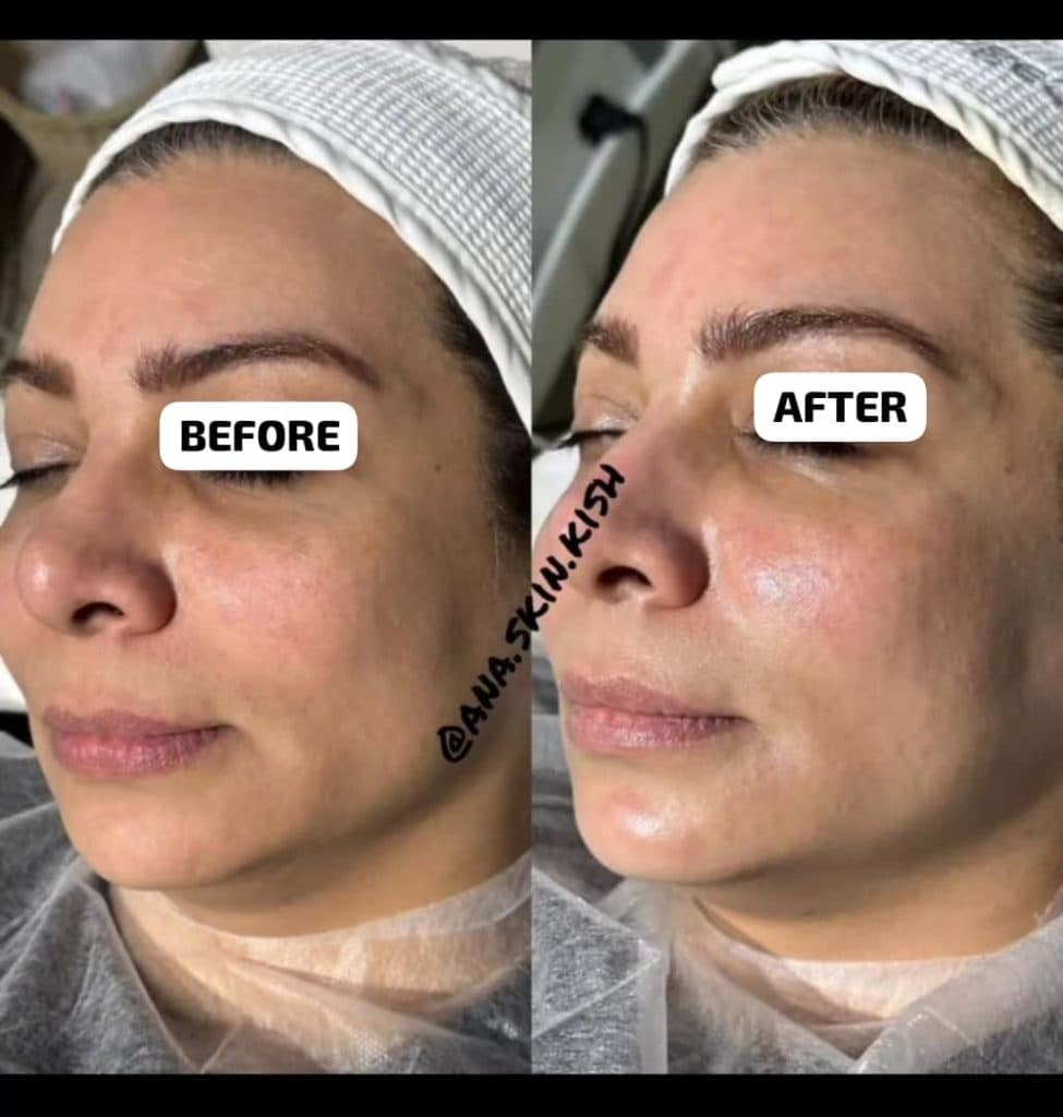 آموزش و خدمات تخصصی پاکسازی پوست آتنا توحیدی در کیش