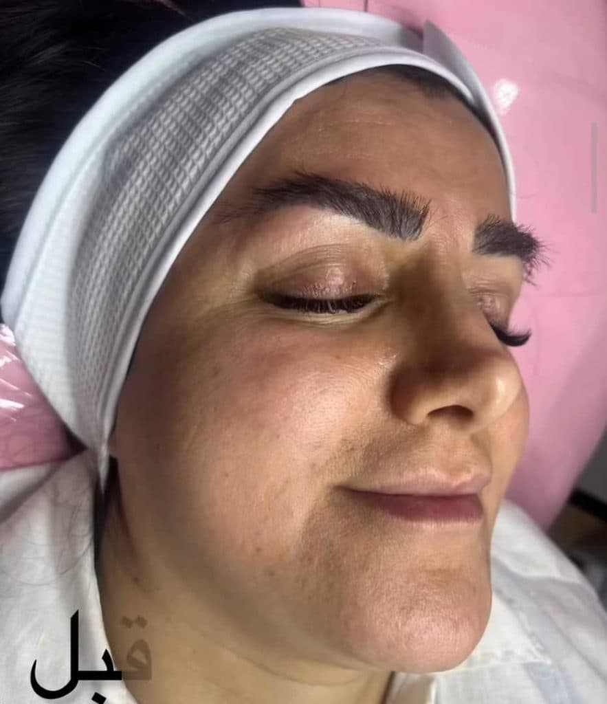 فشیال پوست اخلاصی در نوشهر