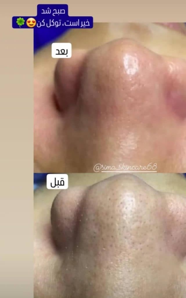آموزش و خدمات تخصصی پاکسازی پوست و فیشال صورت سیما فاتحی در کامفیروز