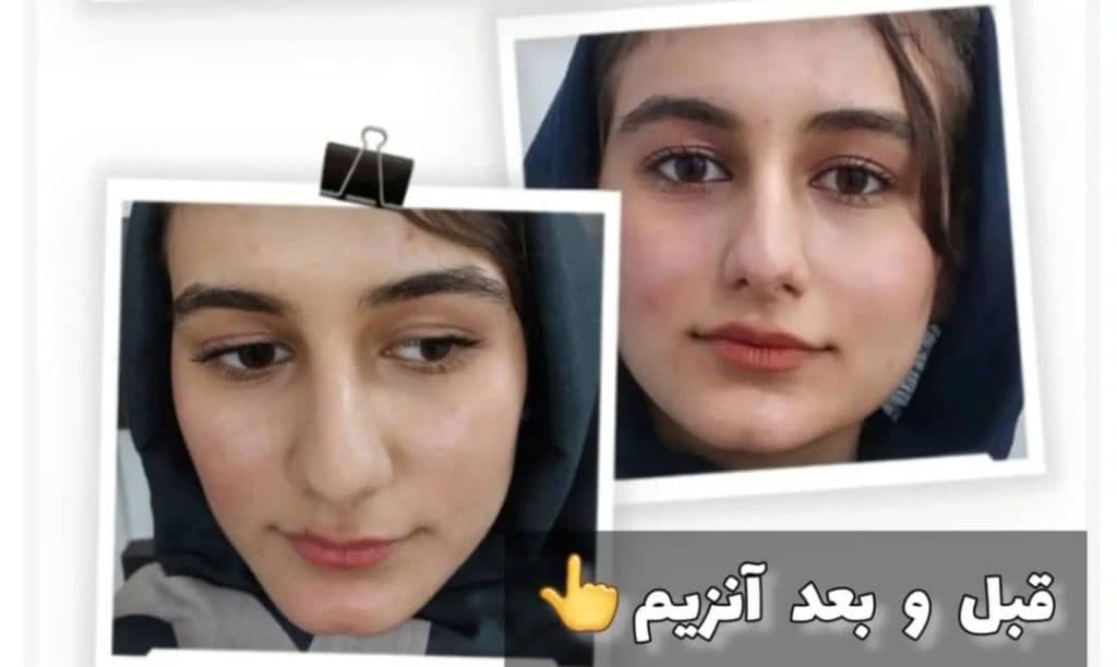 کلینیک زیبایی تزریق فیلر لب روسی بنیتا در تهرانپارس