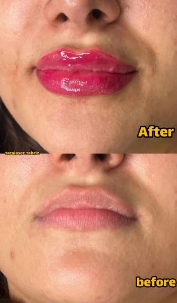 مرکز لیزر تارا در آخر جلالیه تبریز